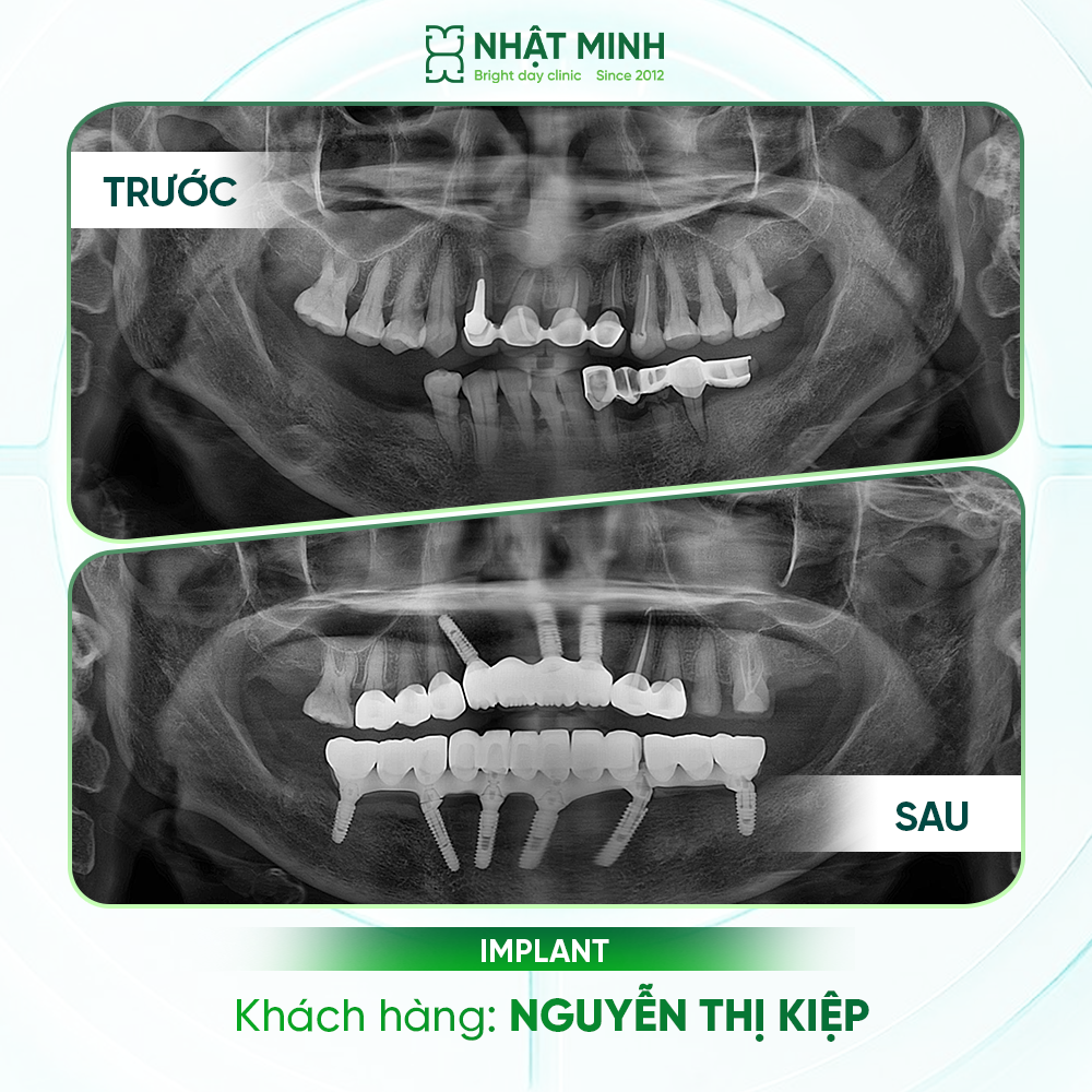 Khách hàng Implant thực tế