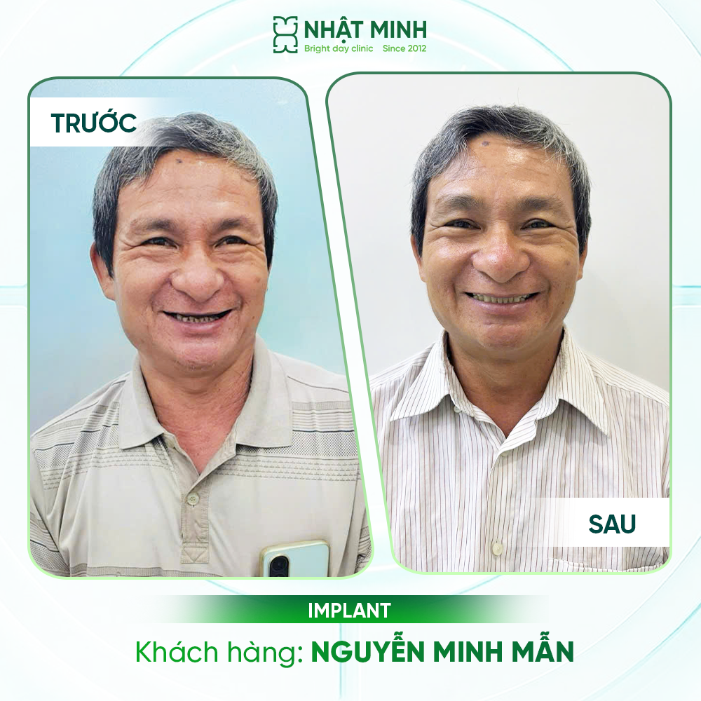 Khách hàng Implant thực tế