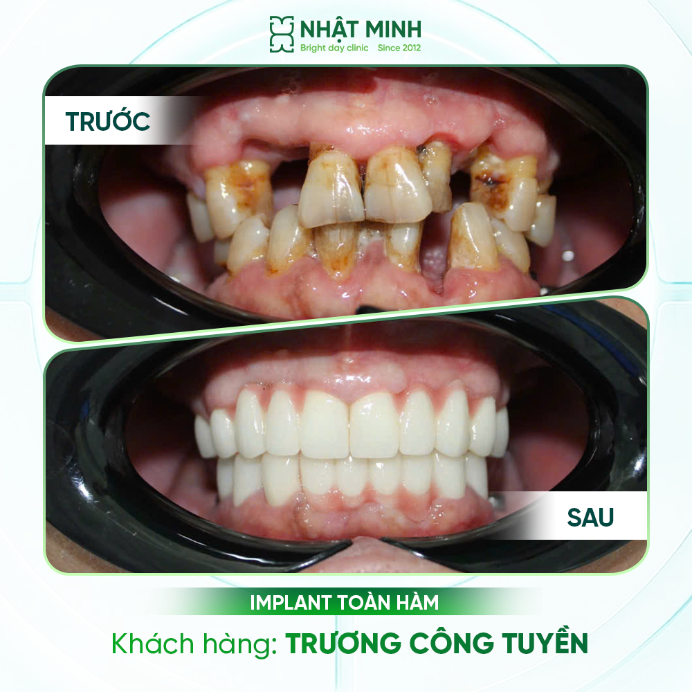 Khách hàng Implant thực tế