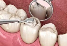 Trám răng thẩm mỹ